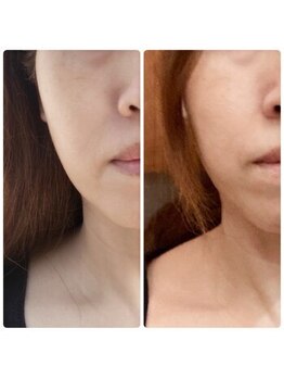 ソレイユ 北千住店(soleil)/フェイスラインのリフトアップに