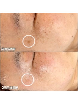 クロッシュ(Cloche)/シミケア