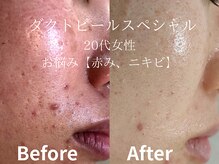 メイプル(Maple)/20代女性/お悩み→肌荒れと赤み