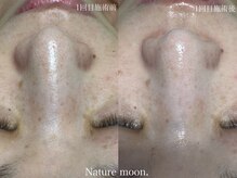 ナチュールムーン(Nature moon.)/毛穴洗浄