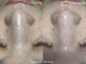 ナチュールムーン(Nature moon.)/毛穴洗浄