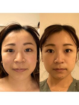 ハリドコロケン(KEN)の写真/《コリを根本から取り去るルート美容鍼》太いルート鍼で顔のコリ、むくみを改善◎自分史上最高の小顔に♪