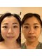 ハリドコロケン(KEN)の写真/《コリを根本から取り去るルート美容鍼》太いルート鍼で顔のコリ、むくみを改善◎自分史上最高の小顔に♪