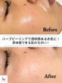 毛穴ラボ 渋谷(毛穴LABO)&nbsp;1回でお肌 白玉肌★