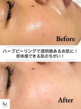 毛穴ラボ 渋谷(毛穴LABO)&nbsp;1回でお肌 白玉肌★