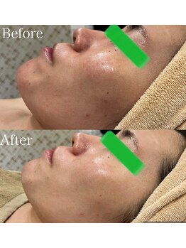 マーレン(Malen)/【クリスティーナ症例写真】