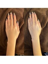 モゼ(moze)/バンドトリートメント