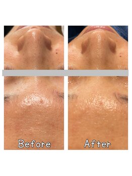 ベリル 金町店(Beryl)/毛穴洗浄