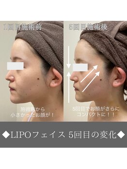 ナンバーファイブクリニカルサロン 札幌店(No.5)/BeforeAfter/リフトアップ&美白