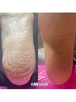 バナナ(Banana)/韓国式角質ケアエスプランニング