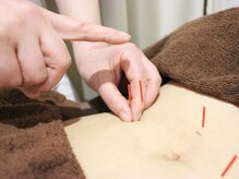 美リレア/大人気☆鍼灸施術