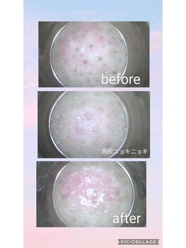 フェローズリンパケア(FELLOWS)/毛穴メニュー