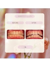 プラスビー 2号店(+b)/ホワイトニングビフォーアフター