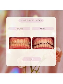 プラスビー 2号店(+b)/ホワイトニングビフォーアフター
