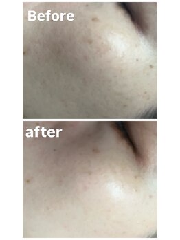 ココ(COCO)/シミケア、ビフォー、アフター