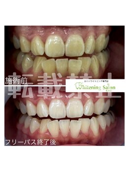ホワイトニングサロン 札幌店/【ホワイトニング】#札幌#大通り
