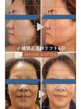 チルアウト 豊見城(Chill out)/効果大！小顔矯正造顔リフト術！