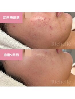 リシェル(Richelle)/【GREENPEELソフト1day】