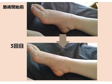 そらのいえ/足のむくみビフォーアフター