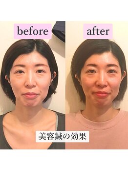 ゲンキ鍼灸整骨院 かどの(Genki鍼灸整骨院)/ほうれい線たるみのケアに美容鍼