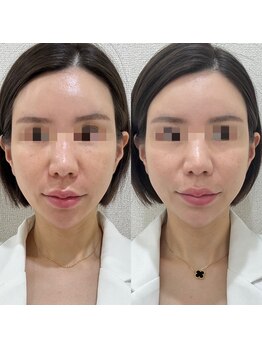 ラ クレール ビューティーサロン(LA CLAIR)/サーマリフトRF