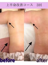 リラ(Lilas)/【痩身】たるみ改善上半身 4回目