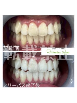 ホワイトニングサロン 札幌店/【ホワイトニング】#札幌#大通り