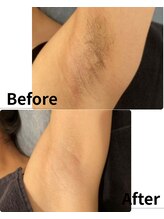 ララ(LALA)/脇脱毛