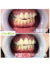 ルブラン 奈良店(Le Blanc)/下の歯も綺麗にしましょう！