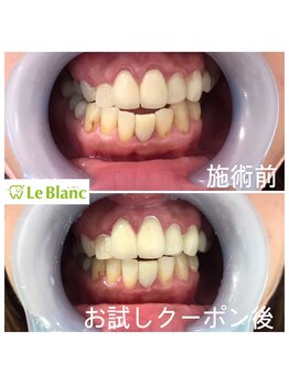 ルブラン 奈良店(Le Blanc)/下の歯も綺麗にしましょう!