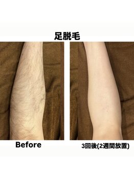 ミノア 大野城店(MINOA)/全身脱毛