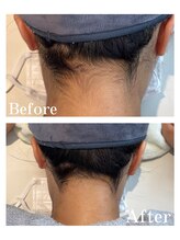 ピュア 川越店/うなじ脱毛