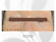 アン ビューティー(ann beauty)/施術1回【症例写真】