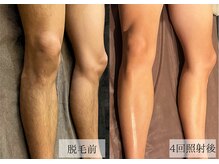 メンズアルファ/【脚】光脱毛before after 20代