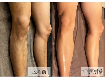 メンズアルファ/【脚】光脱毛before after 20代
