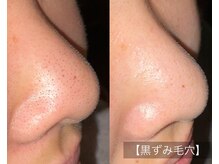 ル シーニュ/黒ずみ毛穴