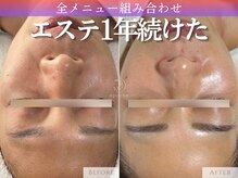 アポシェ(apoche)/ハリ/艶/ほうれい線/透明感/弾力