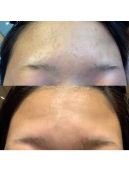 ブランシェ 野々市店 × 椿/リアージュセラム使用前後