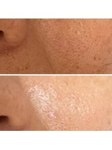 アデル(Adele)/リブセラフェイシヤル