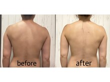 ニコ(25)/オーダーメイド筋膜リリース