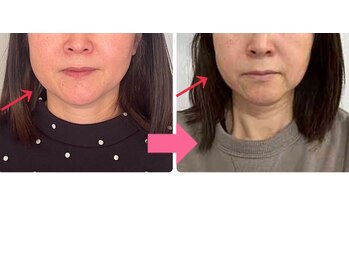 小顔矯正サロン ブルーム/左右差のバランス改善/1回の施術