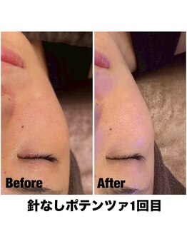 Sスタイルスタジオ 福岡天神/針なしポテンツァ1回目