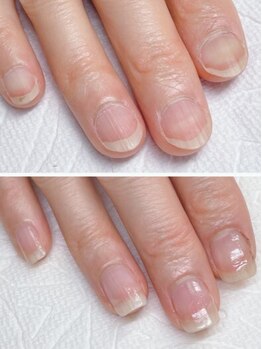 ティアラ(Tiara)の写真/【最強のネイルケアメソッド】深爪・二枚爪・平らな爪・乾燥などのお悩みを解消し縦長の美しい爪を育てる☆