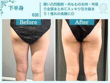 フローフシ∞/【痩身】下半身・お尻の脂肪撃退