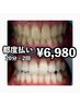 【どなたでも利用可！】美白ホワイトニング20分×2回　￥6,980