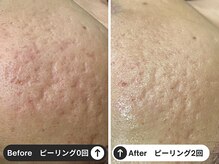 脱毛/ハーブピーリング　TRYSHIFT　品川大井町店