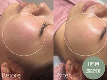 ラティエ(Latier)/肌質改善