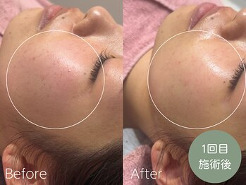 ラティエ(Latier)/肌質改善