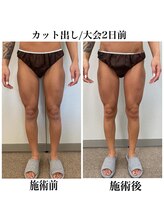 ヴィーナス(Venus)/スタッフ施術/下半身カット出し