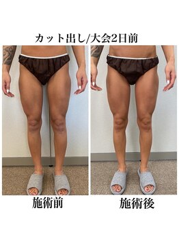 ヴィーナス(Venus)/スタッフ施術/下半身カット出し